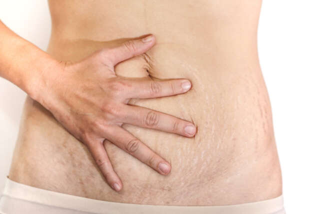 extra skin after pregnancy