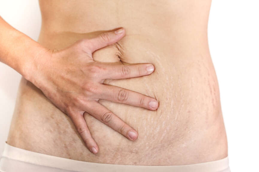extra skin after pregnancy