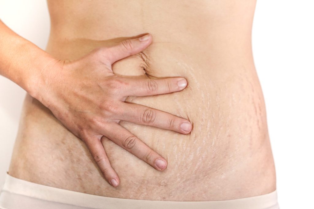 extra skin after pregnancy